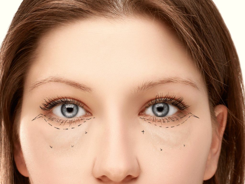 Czy plastyka powiek jest bezpieczna