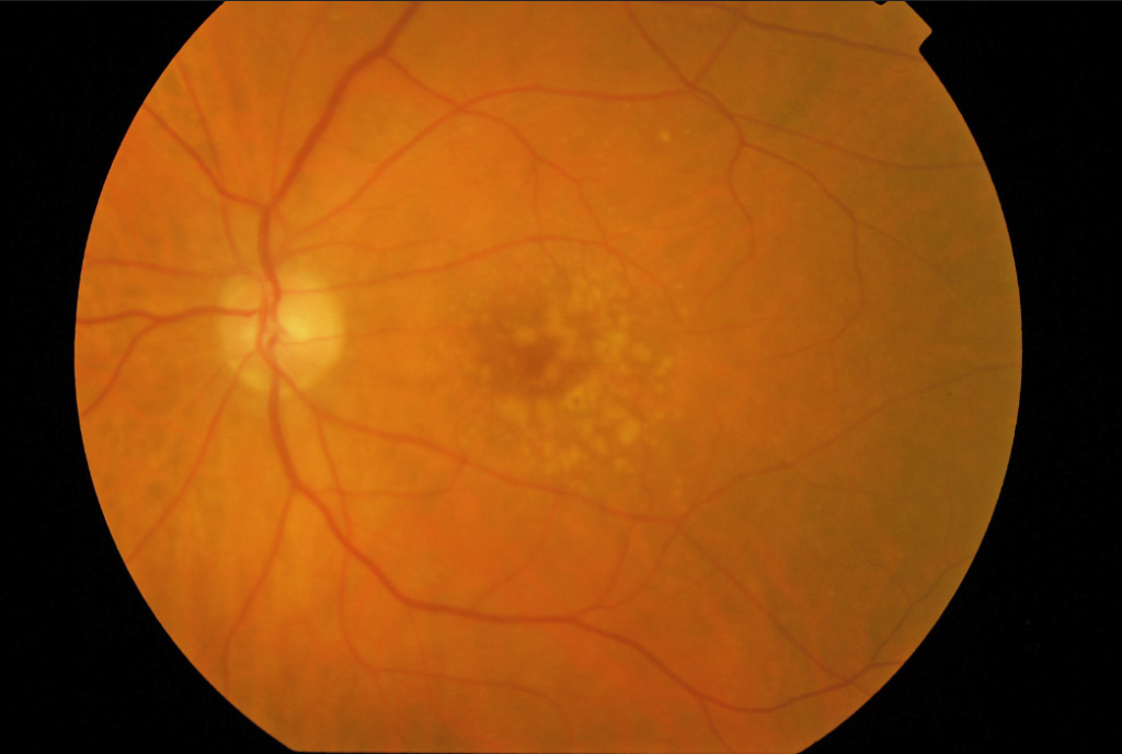 choroby siatkówki oka